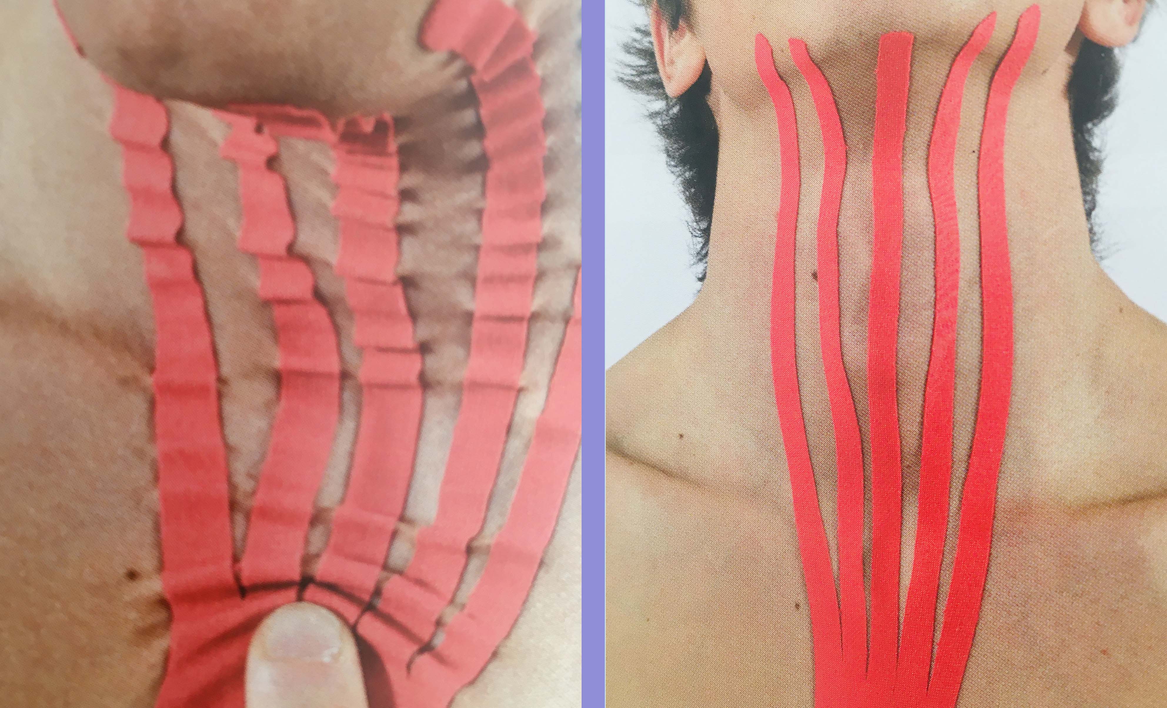 Radioterapia drenaggio edemi linfotaping